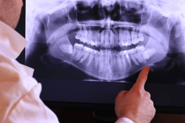 Best Knocked-Out Tooth (Avulsed Tooth) Treatment in De Soto, MO